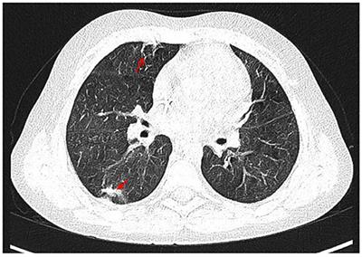 A Novel CDC42 Mutation in an 11-Year Old Child Manifesting as Syndromic Immunodeficiency, Autoinflammation, Hemophagocytic Lymphohistiocytosis, and Malignancy: A Case Report